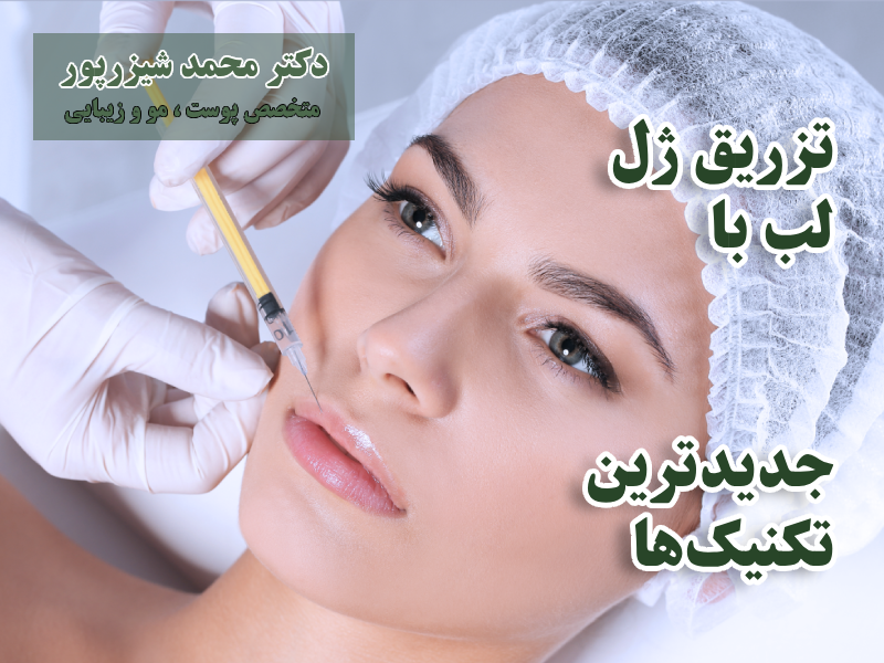 انواع تکنیک‌های تزریق ژل لب