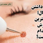 برداشتن خال