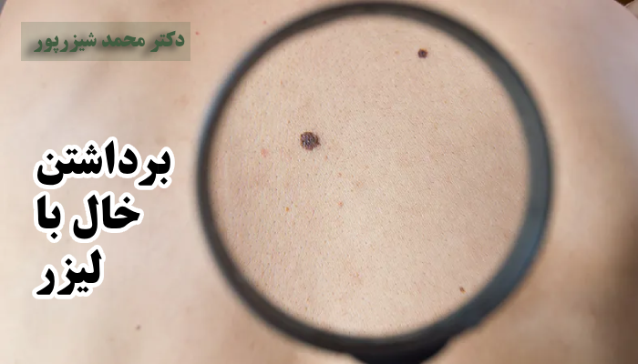 برداشتن خال با لیزر