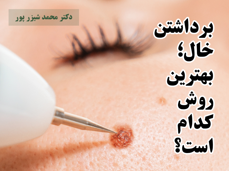 برداشتن خال