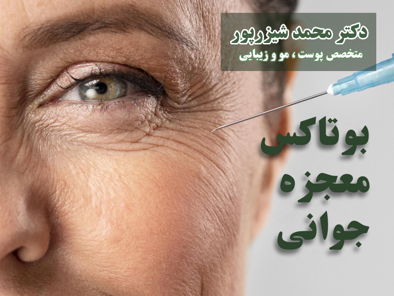 تزریق بوتاکس