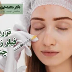 تزریق فیلر زیر چشم