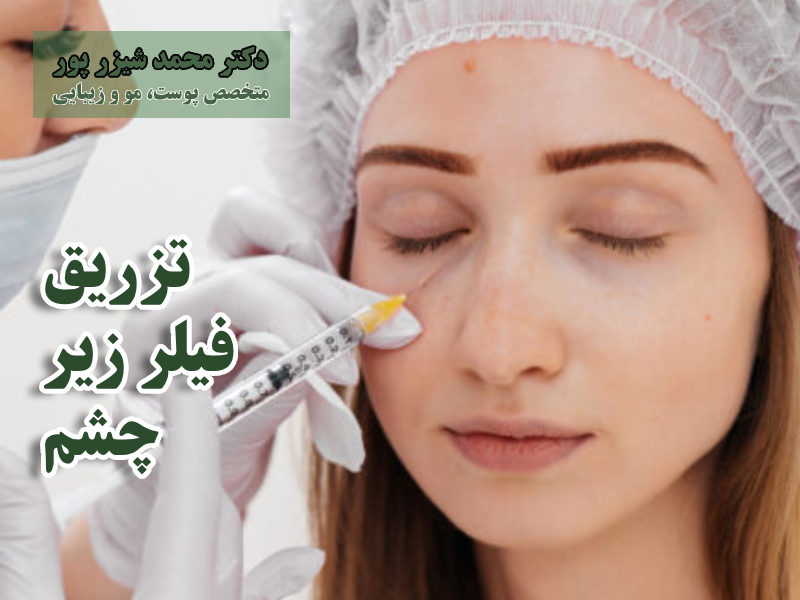 تزریق فیلر زیر چشم