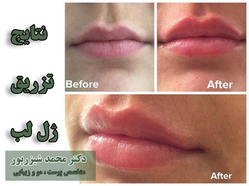 فواید تزریق ژل لب