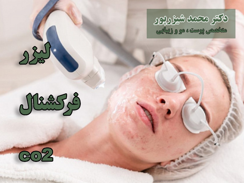 لیزر فرکشنال co2