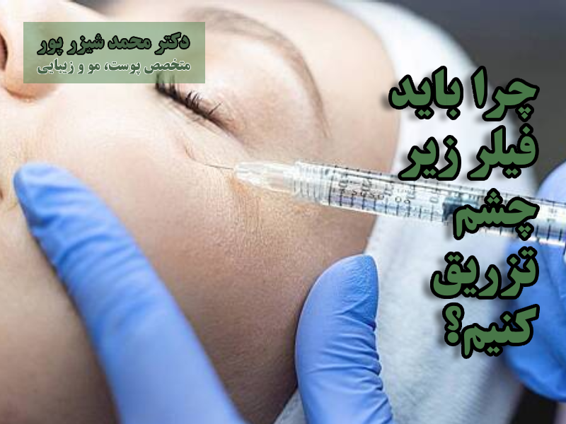 چرا باید فیلر زیر چشم تزریق کنیم؟