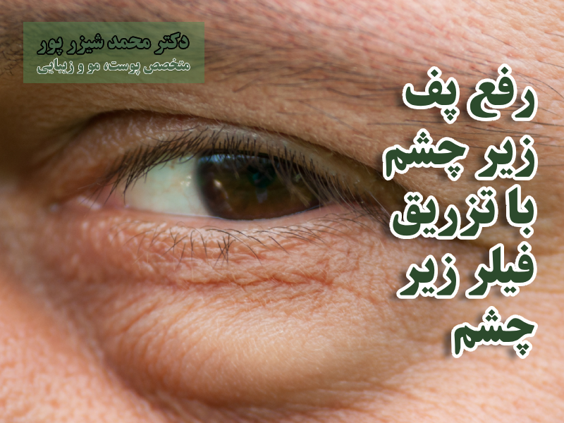 کاربردهای تزریق فیلر زیر چشم