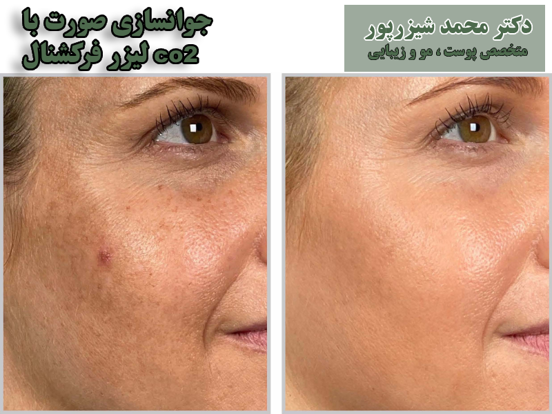 کاربردهای لیزر فرکشنال co2