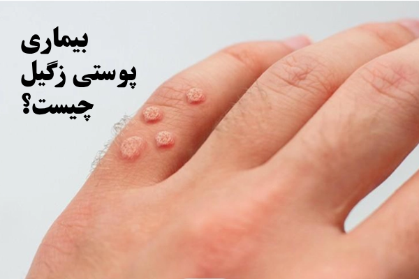بیماری پوستی زگیل چیست؟