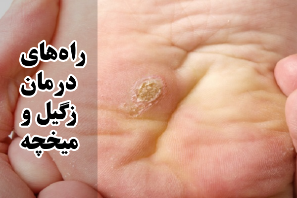 راه‌های درمان زگیل و میخچه
