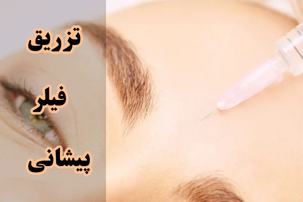 مزایا و معایب تزریق فیلر پیشانی