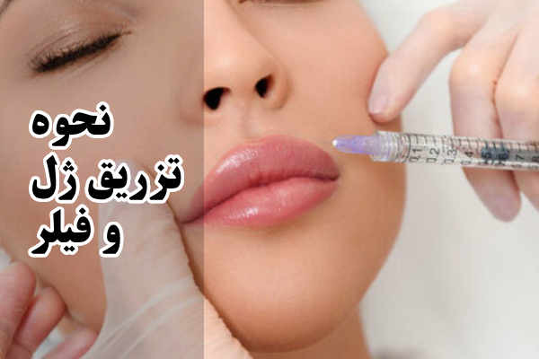 نحوه تزریق ژل و فیلر
