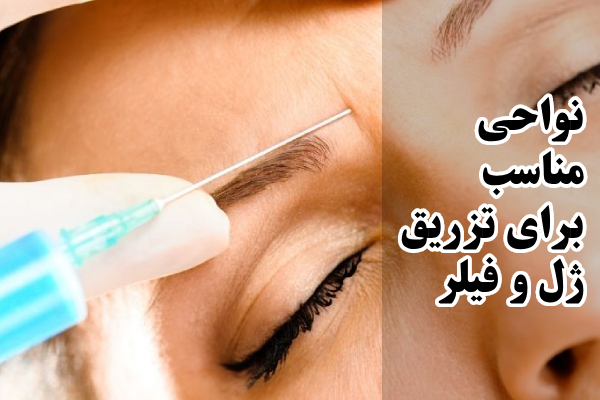 نواحی مناسب برای تزریق ژل و فیلر