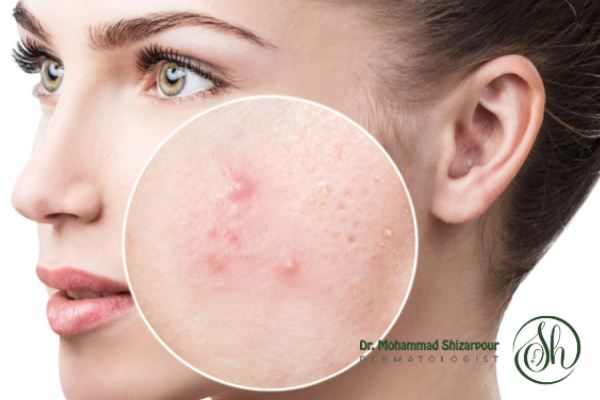 آکنه و جوش چیست؟