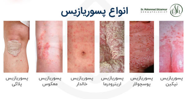 انواع پسوریازیس