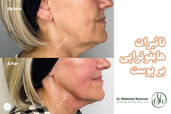 تاثیرات تزریق ژل بعد از هایفوتراپی بر پوست