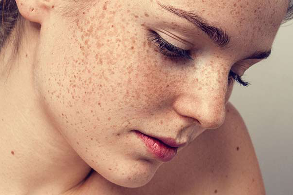 بیماری ملاسما چیست؟
