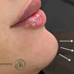 تزریق ژل چانه: روشی موثر برای زیبایی و تغییر شکل چانه