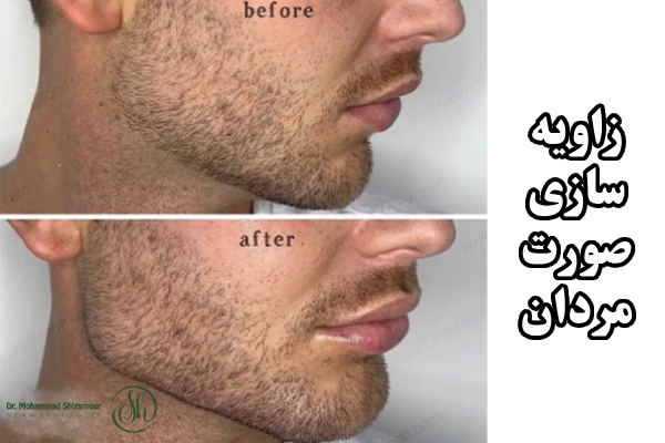 چه کسانی کاندید مناسب زاویه سازی صورت هستند؟
