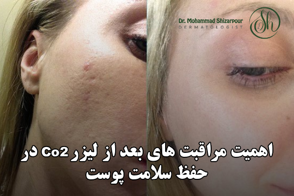 اهمیت مراقبت های بعد از لیزر CO2 در حفظ سلامت پوست