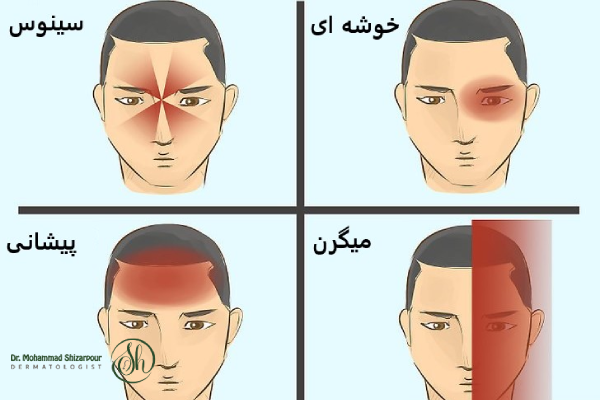 عوارض احتمالی درمان سردرد با بوتاکس