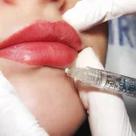 مراقبت های بعد از تزریق ژل لب-شاخص