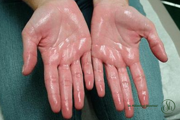 معایب و عوارض تزریق بوتاکس کف دست