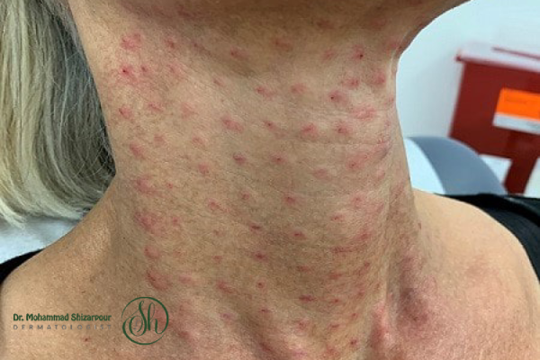 مراقبتهای قبل از تزریق بوتاکس گردن