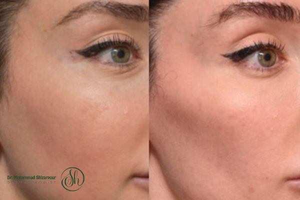 تزریق ژل گونه چیست و چگونه انجام میشود؟