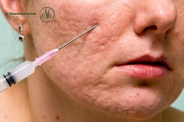 سابسیژن پوست چیست و چگونه عمل میکند؟