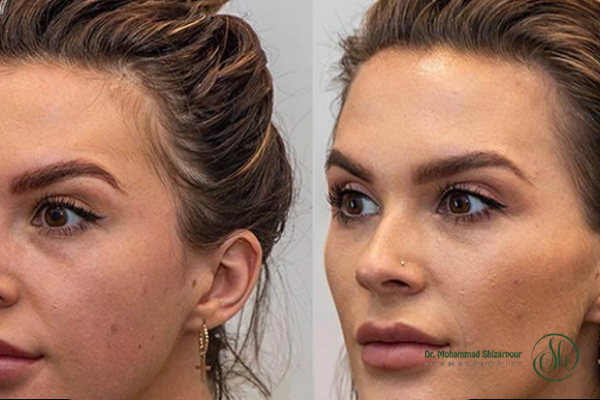مراقبتهای لازم پس از تزریق ژل گونه