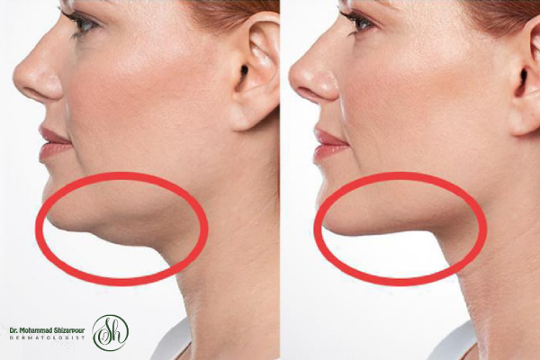 هایفوتراپی برای غبغب چگونه عمل میکند؟